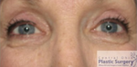 Blepharoplasty