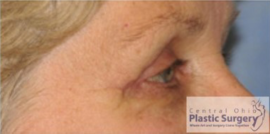 Blepharoplasty