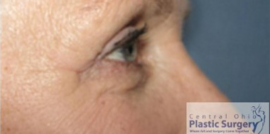 Blepharoplasty