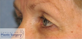 Blepharoplasty