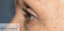 Blepharoplasty