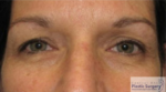 Blepharoplasty