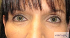 Blepharoplasty