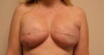 Breast Reconstruction