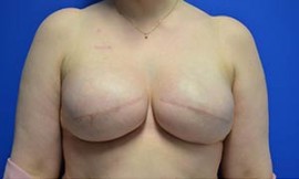 Breast Reconstruction