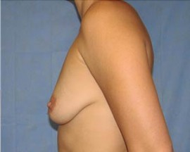 Breast Augmentation