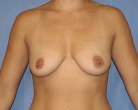 Breast Augmentation