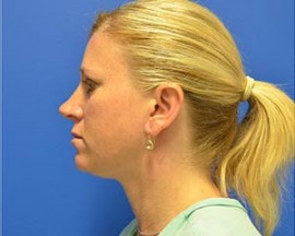 Liposuction (Neck)