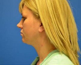 Liposuction (Neck)