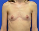 Breast Augmentation