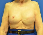 Breast Reconstruction