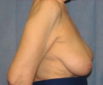 Breast Reconstruction