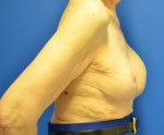 Breast Reconstruction