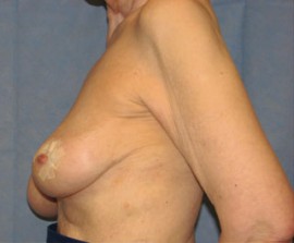 Breast Reconstruction