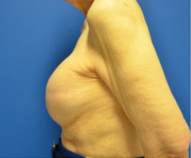 Breast Reconstruction