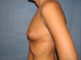 Breast Augmentation