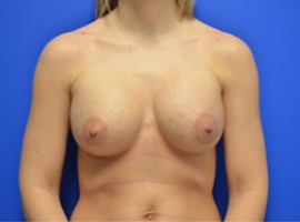 Breast Augmentation