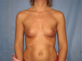 Breast Augmentation