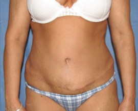 Tummy Tuck