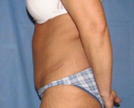 Tummy Tuck