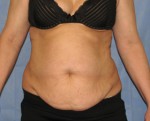 Tummy Tuck