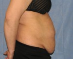 Tummy Tuck