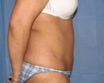 Tummy Tuck