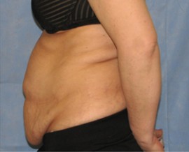 Tummy Tuck