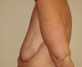 Breast Augmentation with Lift