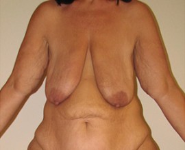 Breast Augmentation with Lift