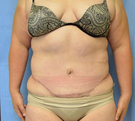 Tummy Tuck