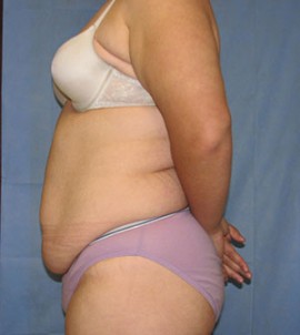 Tummy Tuck