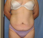 Tummy Tuck