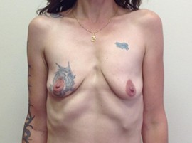 Breast Augmentation