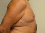 Male Breast Reduction (Gynecomastia)