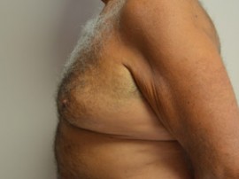 Male Breast Reduction (Gynecomastia)