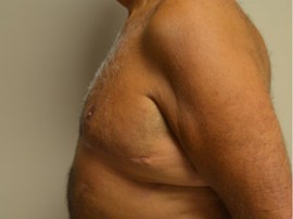 Male Breast Reduction (Gynecomastia)