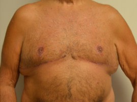 Male Breast Reduction (Gynecomastia)