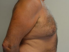 Male Breast Reduction (Gynecomastia)