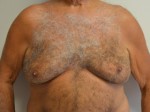 Male Breast Reduction (Gynecomastia)