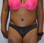 Tummy Tuck