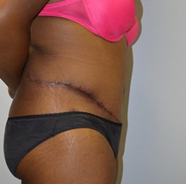 Tummy Tuck