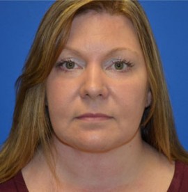 Facelift & Necklift