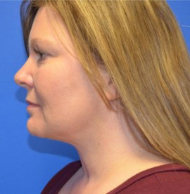 Facelift & Necklift