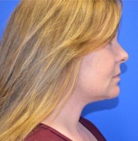 Facelift & Necklift