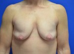 Breast Augmentation