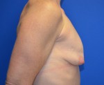 Breast Augmentation