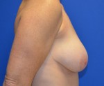 Breast Augmentation