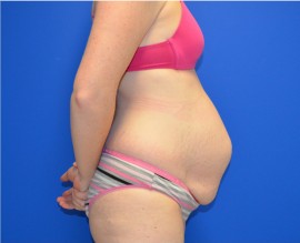 Tummy Tuck