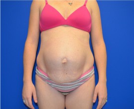 Tummy Tuck